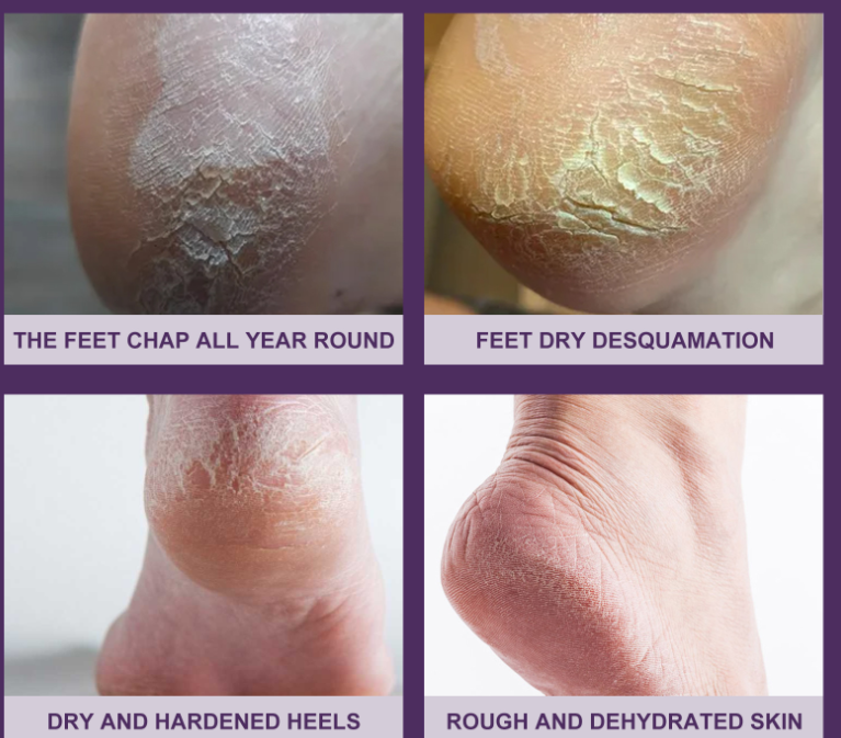 Foot Care Cream Moisturizes And Exfoliates Feet