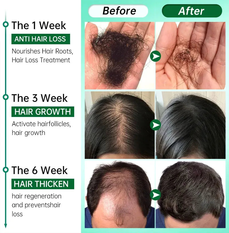 Sérum  de croissance des cheveux en 7 jours a base de  gingembre Produits anti-perte Produits de repousse des 4cheveux Réparer Nourrir les cheveux a4bîmés Huile de soin du cuir chevelu P4our les femmes Hommes